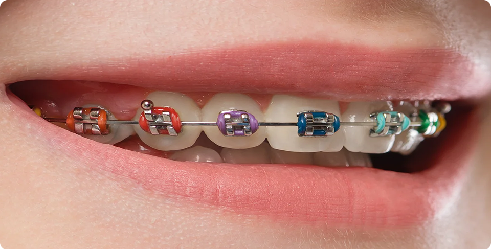 Metal Braces 